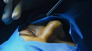 الفطر الأسود مجددا في العراق.. الإعلان عن حالة وفاة في كركوك